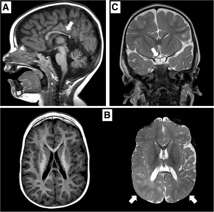 【佳学基因检测】德莫塞尔综合征分子诊断怎么做De Morsier syndrome？