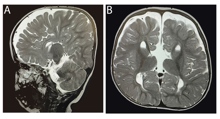 【佳学基因检测】唐奈-巴罗综合征基因检测(DBS)及其治疗 【佳学基因检测】唐奈-巴罗综合征基因检测(DBS)及其治疗