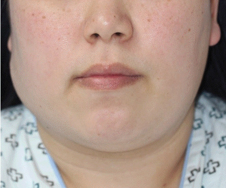 【佳学基因检测】巨大毛母质瘤的基因检测案例