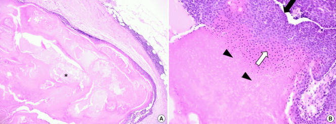 【佳学基因检测】巨大毛母质瘤的基因检测案例
