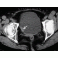 【佳学基因检测】膀胱癌基因检测的依据、实施及靶向药物治疗
