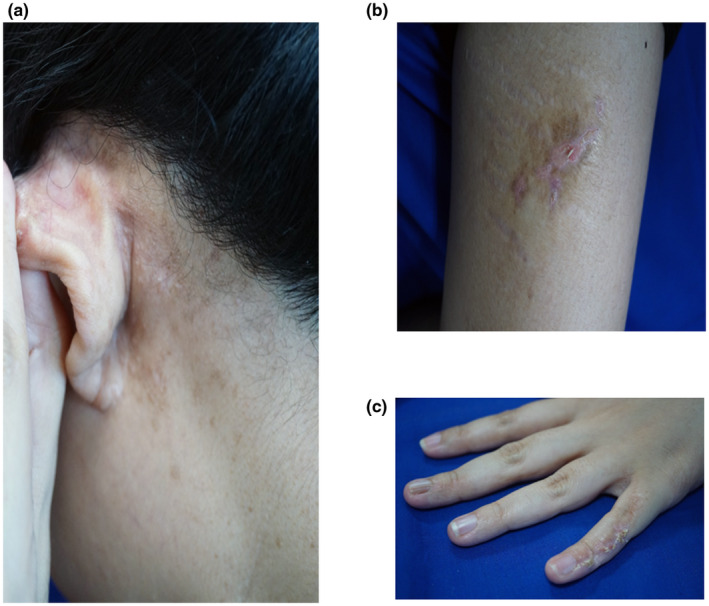 【佳学基因检测】CHILD综合征基因解码、基因检测有什么用？