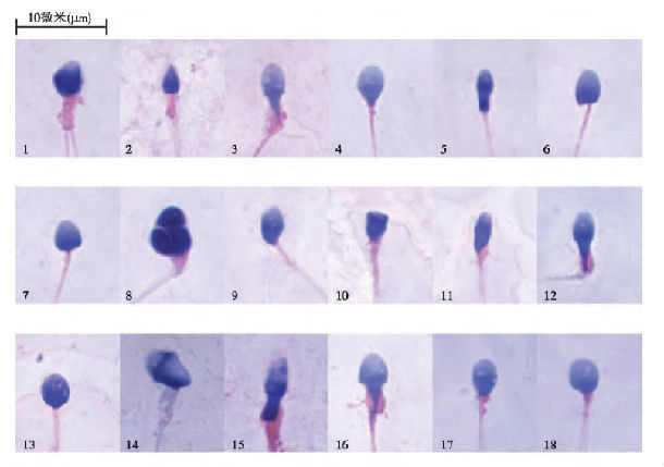 【佳学基因检测】畸形精子症基因解码、基因检测 【佳学基因检测】畸形精子症基因解码、基因检测