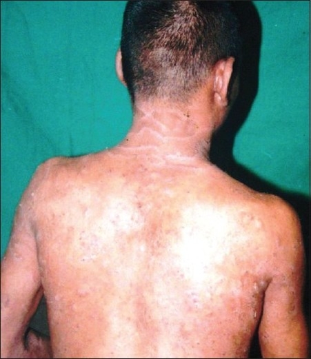 【佳学基因检测】竹节状头发综合征基因检测Bamboo hair syndrome