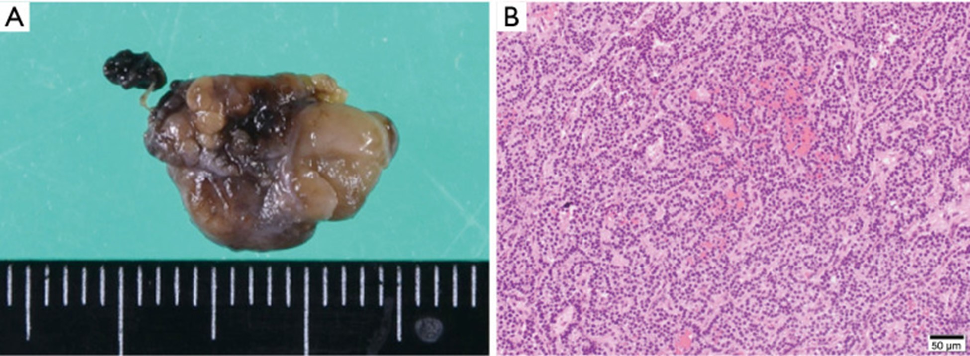 【佳学基因检测】原发性甲状旁腺功能亢进及钙代谢基因解码基因检测