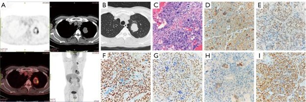 【佳学基因检测】男性原发性肺绒毛膜癌基因检测报告