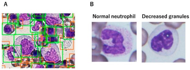 【佳学基因检测】骨髓增生异常综合征的基因解码与基因检测：诊断和筛查基础