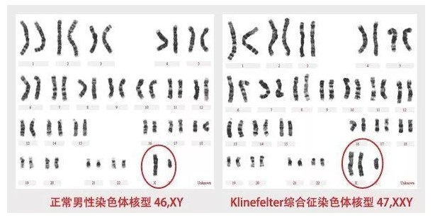 【佳学基因检测】最新：针对克氏综合征患者显微取精成功率的预测分析